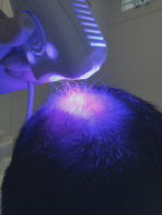 Led e Laser
